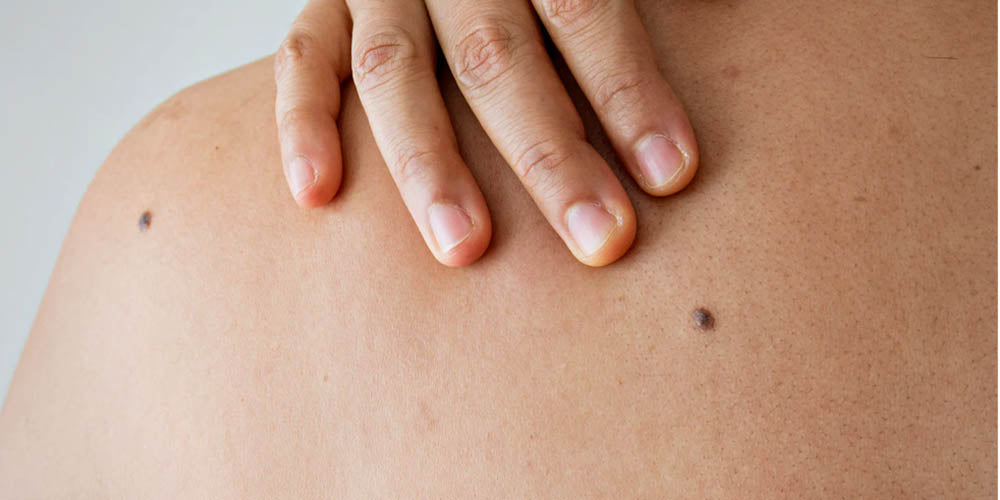 Jade's Skin Cancer Story