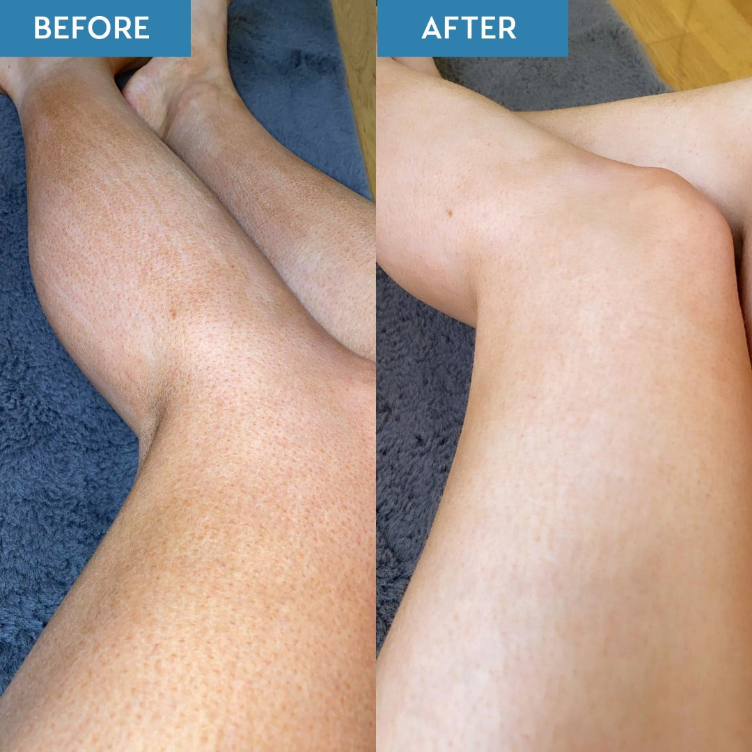 Before and after image of woman's legs. The before image shows old, patchy tan while the second image shows smooth skin with the tan completely removed